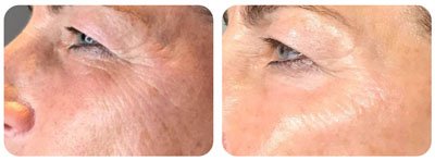 Microneedling (Eyes) 